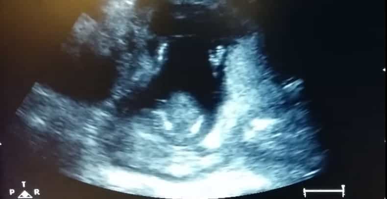 WATCH: Incredible scan film shows baby clapping along with mum’s singing