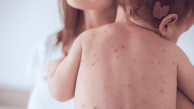 18 of the 20 diagnosed in Limerick’s measles outbreak were unvaccinated