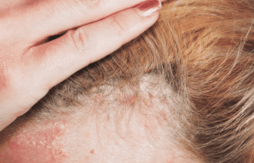 Woman claims her psoriasis disappeared after using €5.30 baby moisturiser