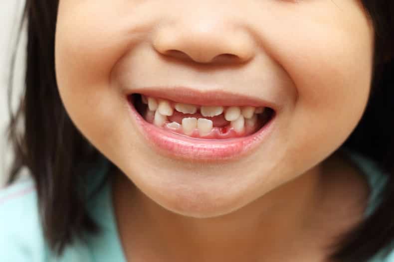 Chemical exposure in pregnancy shows up in baby teeth (and there is a scary link to autism too)