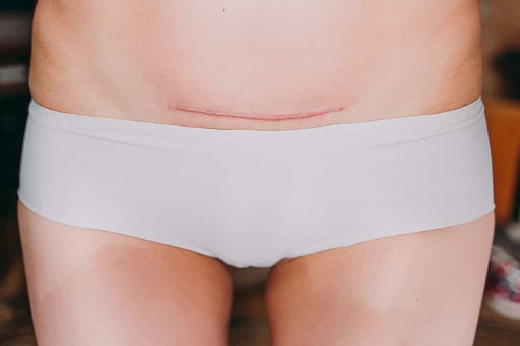 Viral video shows exactly what a person goes through when they have a c-section