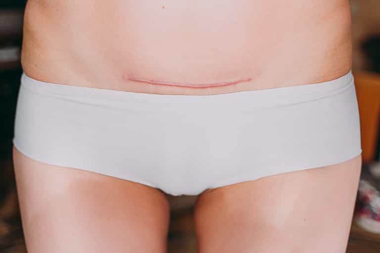 Mum recalls how she had to catch her own intestines after c-section scar burst