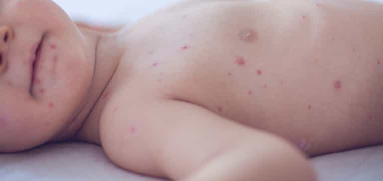 Measles outbreak in Donegal spreading with at least seven confirmed cases