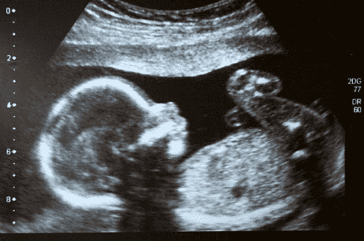 A baby in South America was born with her own twin growing inside of her