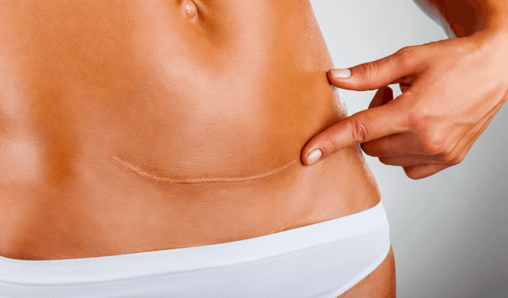 C-section recovery: We asked C-section mums to share their best tips and tricks