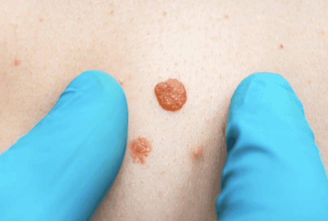 Boots now offering crucial mole scanning service in 17 stores nationwide