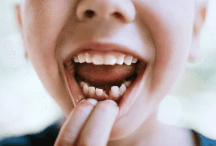 Indian boy has over 500 teeth removed after complaining of pain in his jaw