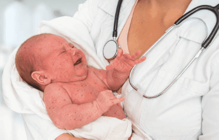 Four European countries lose measles-free status, says WHO