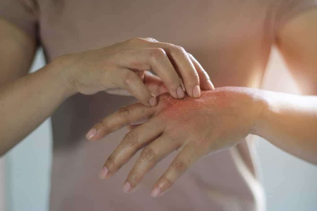 Psoriasis Awareness Month: Top 10 questions about the skin condition answered