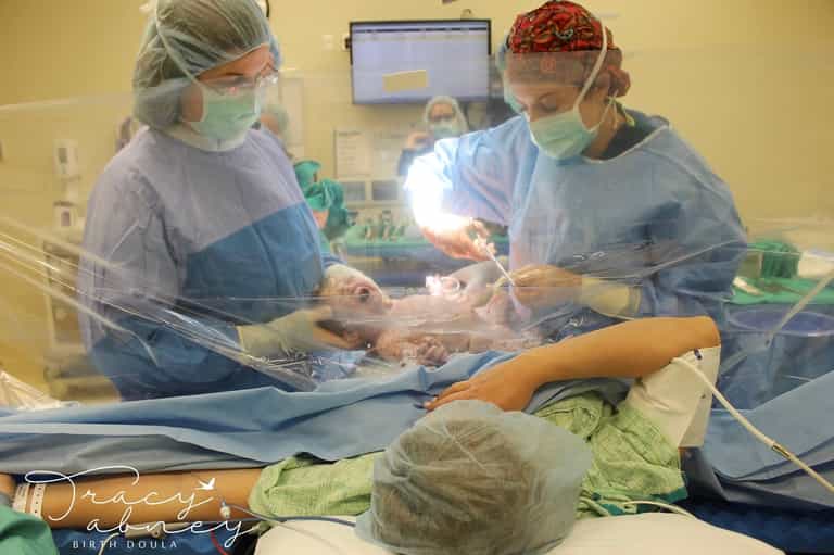 A ‘Clear drape C-section’ allows people see their cesarean birth happening A ‘Clear drape C-section’ allows people see their cesarean birth happening