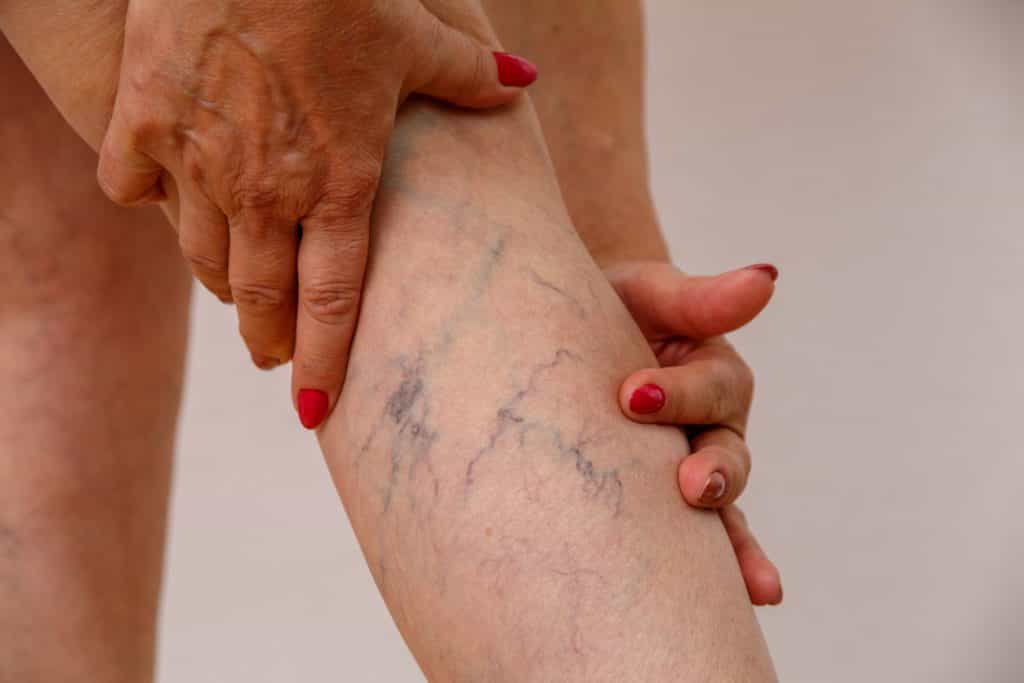 Varicose veins and women: How do you recognise them and can you avoid them?