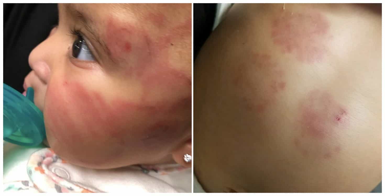 6-month-old baby left ‘covered in bruises’ after being alone with older child at creche