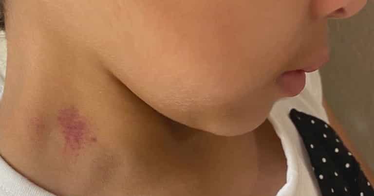 Mum shocked to find hickeys on bullied 6-year-old’s neck after school