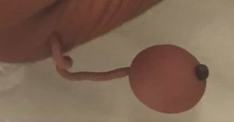Premature newborn born with human tail