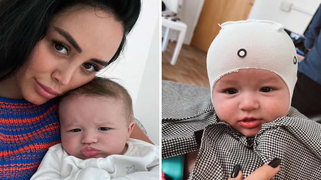 Marnie Simpson reveals her baby boy has plagiocephaly