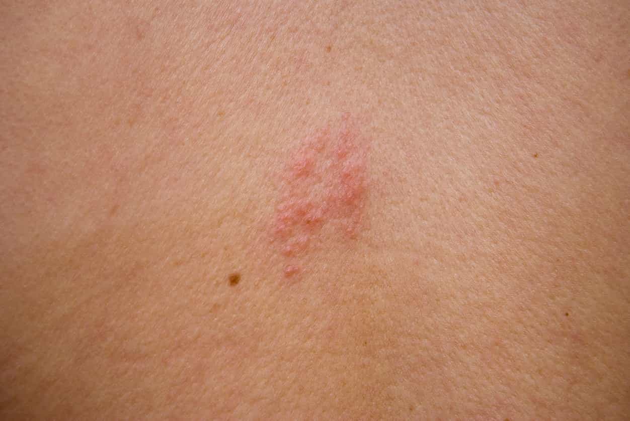 HSE issues shingles warning – here are the symptoms to look out for