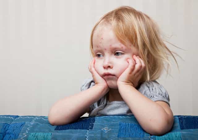 The signs of chickenpox to look out for in kids ‘before the rash appears’