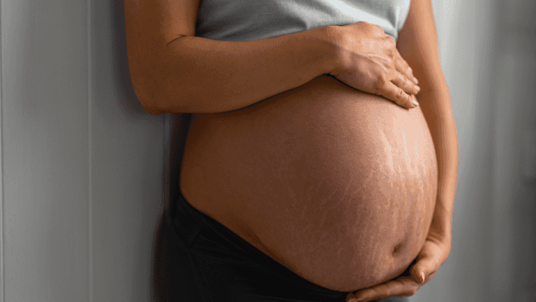 Can you prevent stretch marks in pregnancy? Can you prevent stretch marks in pregnancy?