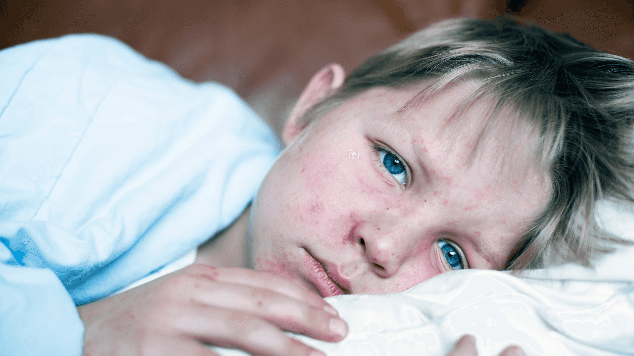 How you can protect you and your family against measles as cases increase