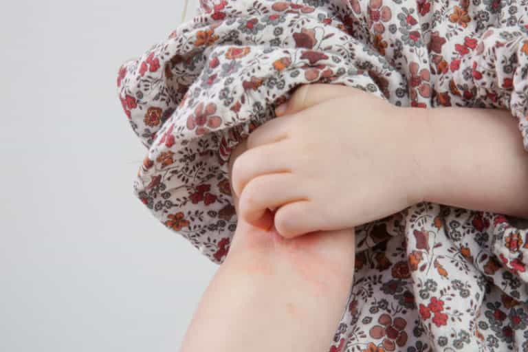 The signs of scabies to beware of as cases triple in one year The signs of scabies to beware of as cases triple in one year