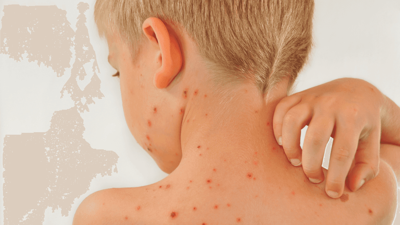 Parents urged to be ‘Chickenpox Aware’ following recent figures