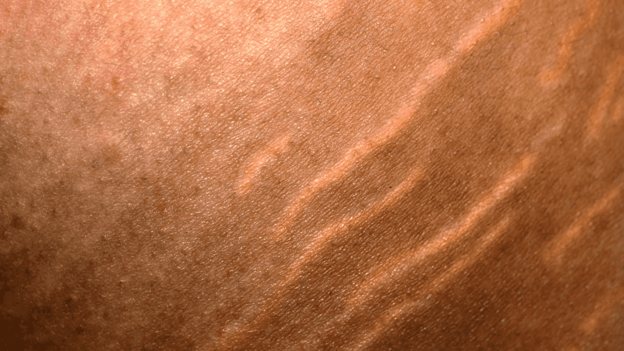 ‘The results can be amazing’ – Irish aesthetician explains how to treat stretch marks