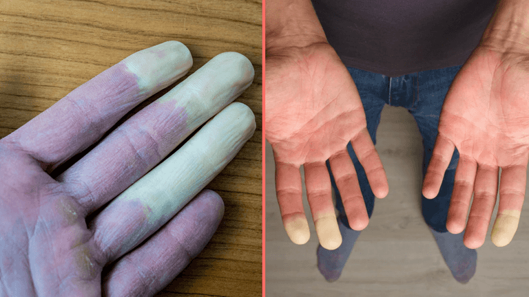 Millions of women suffer common disease where fingers turn white during winter months Millions of women suffer common disease where fingers turn white during winter months