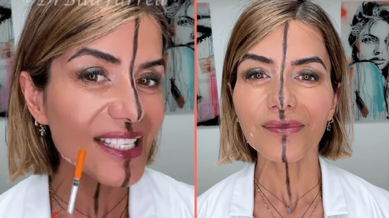 Doctor reveals the side effects of Botox after injecting only one side of her face Doctor reveals the side effects of Botox after injecting only one side of her face