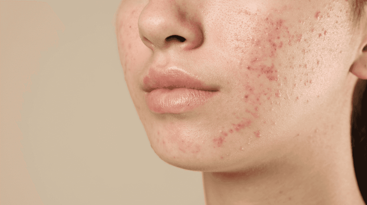 ‘I’m a dermatologist and I swear by this one thing for fading scars’