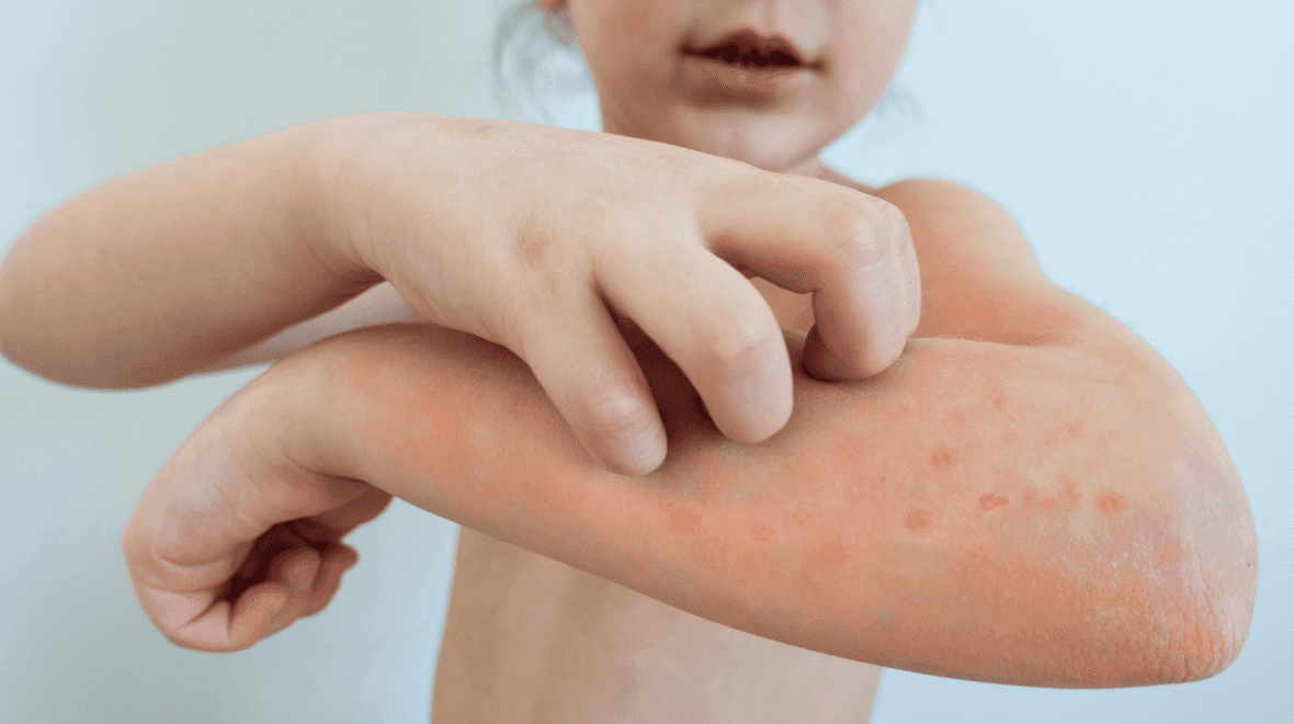 Advice issued to pregnant women amid chickenpox outbreak in Ireland