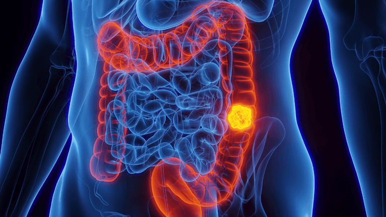 Doctor reveals what foods he saw in diets of 80% of colon cancer cases