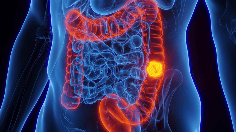 Doctor reveals what foods he saw in diets of 80% of colon cancer cases
