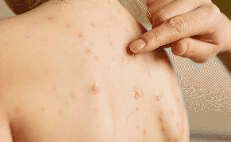 Parents urged to be wary as five measles cases confirmed in Dublin Parents urged to be wary as five measles cases confirmed in Dublin