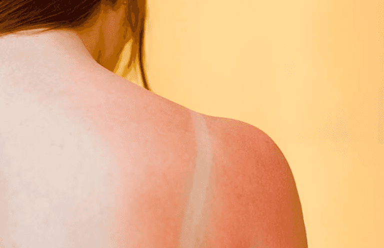 Mum claims her 30-minute shaving foam hack will help get rid of sunburn