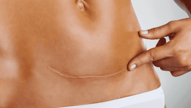 C-section shaming is a thing – and if it has happened to you, you will feel this