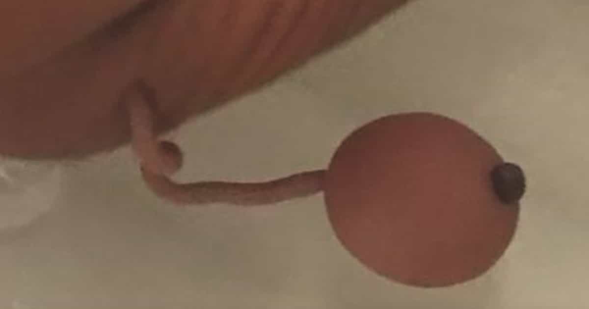 Premature newborn born with human tail
