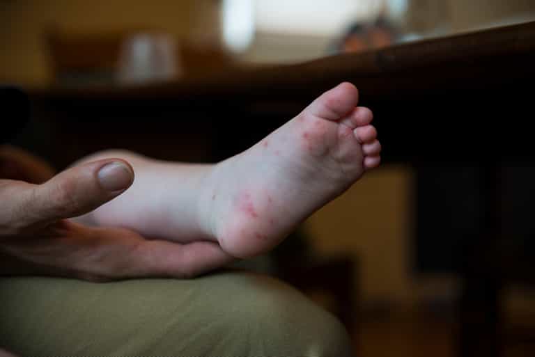 HSE urges parents to keep children with Hand, Foot and Mouth disease out of school HSE urges parents to keep children with Hand, Foot and Mouth disease out of school