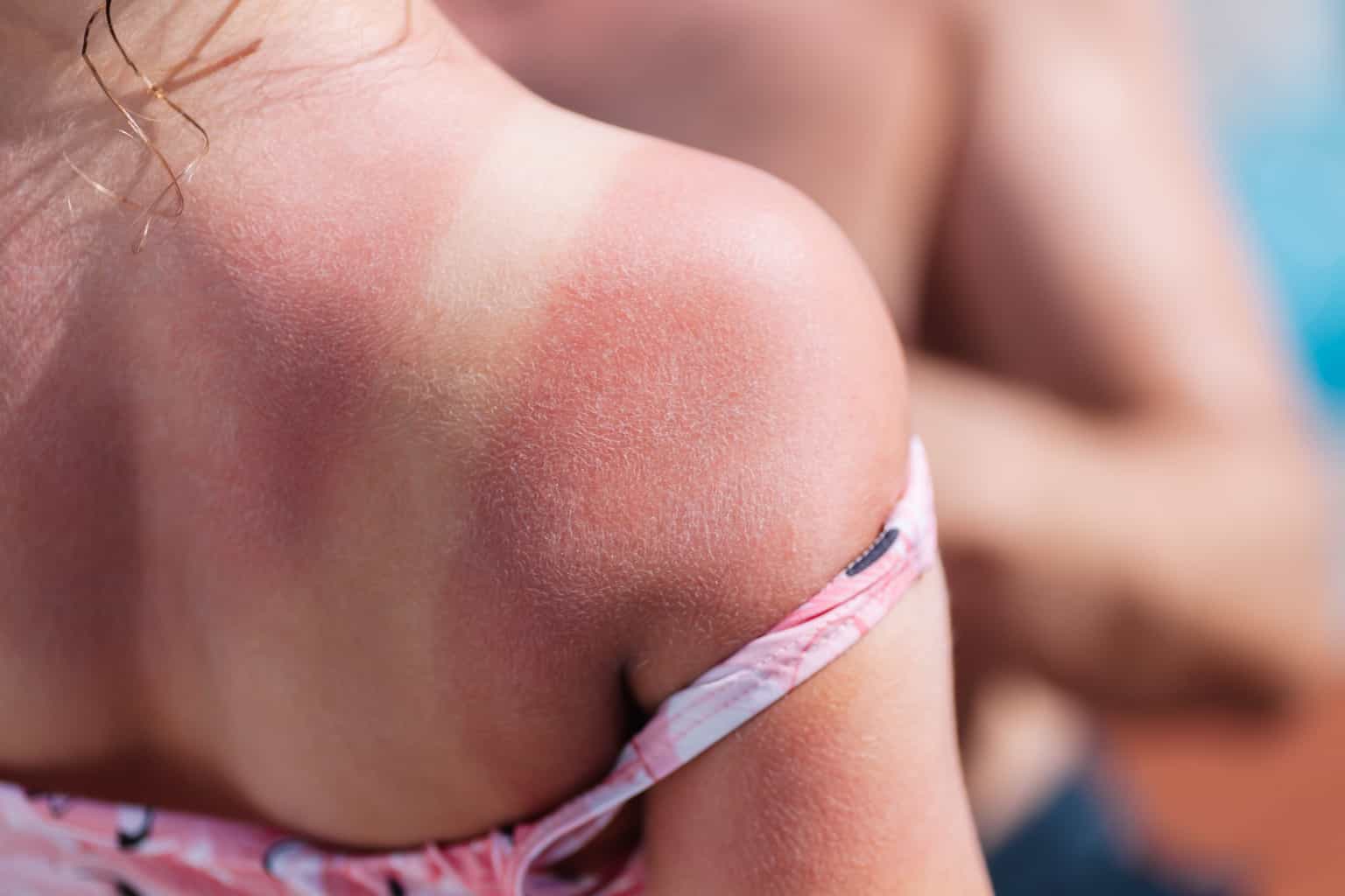 Stock up on suncream – Met Éireann says heat wave is here to stay as charity warns of sunburn