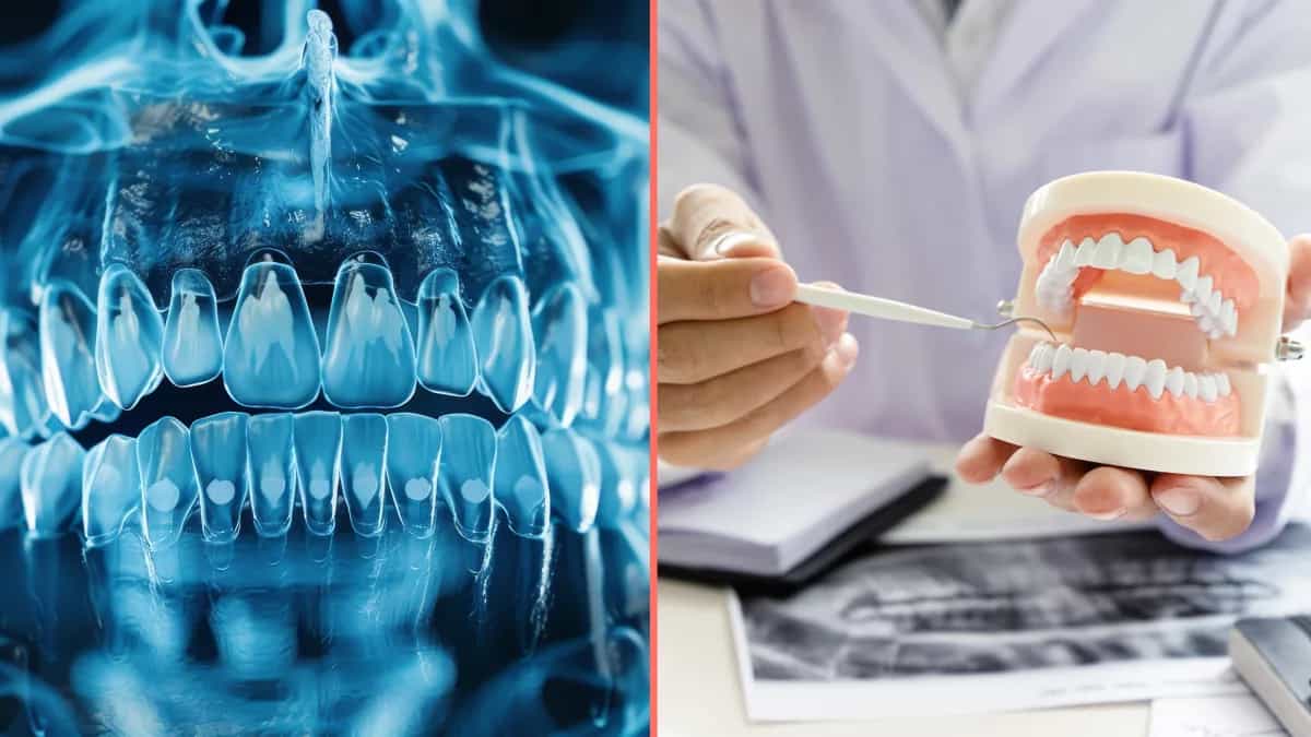 Cause of Alzheimer’s might be coming from inside your mouth, scientists find