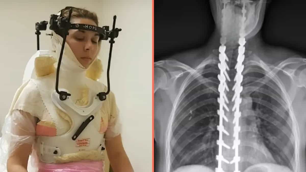 Woman has skull reattached after being ‘decapitated’ in freak football injury