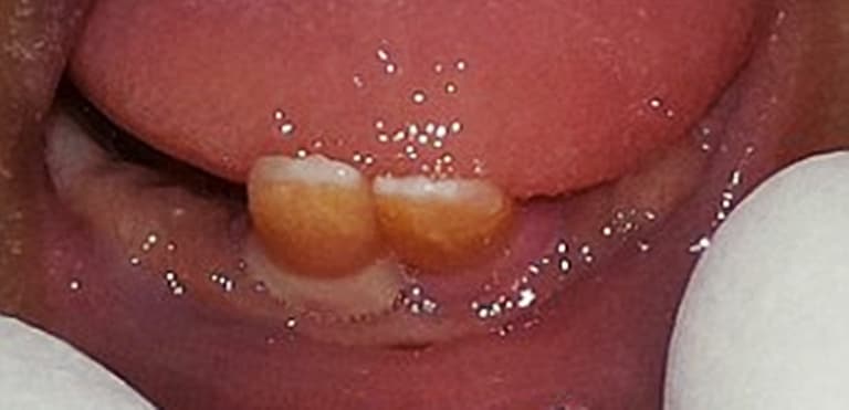 Twins BOTH born with front teeth, breastfeed anyway