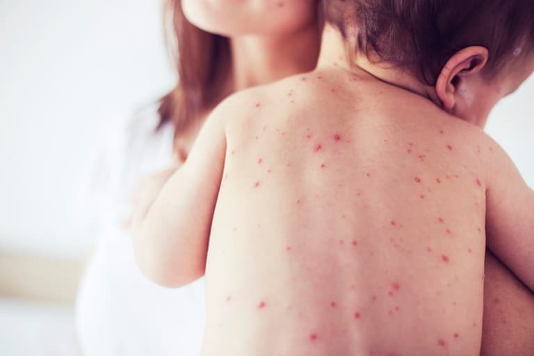 Chickenpox costing Irish parents up to €1,000 as they’re forced to take time off work Chickenpox costing Irish parents up to €1,000 as they’re forced to take time off work
