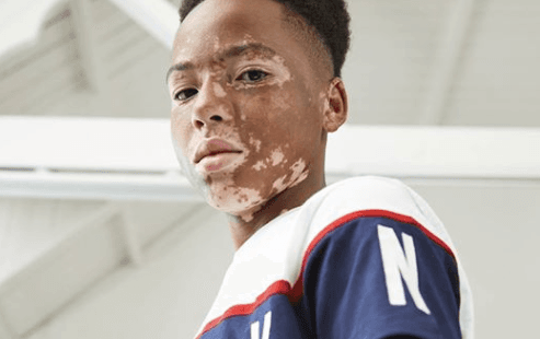 Penneys praised for including teenage model with vitiligo in new campaign
