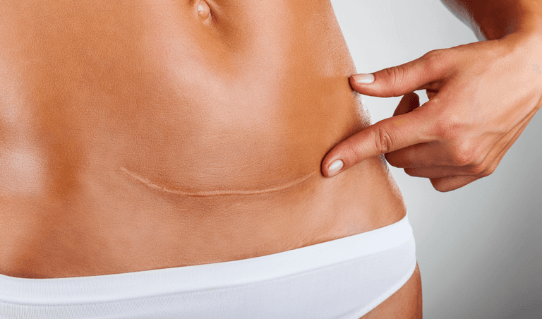 C-section recovery: We asked C-section mums to share their best tips and tricks