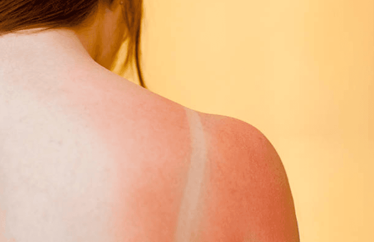 Got some sun yesterday? An Irish pharmacist shares the best ways to heal sunburn Got some sun yesterday? An Irish pharmacist shares the best ways to heal sunburn