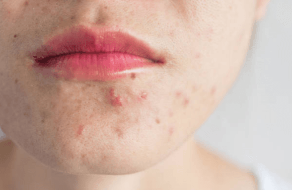 6 steps for treating acne in adulthood, according to a skin therapist 6 steps for treating acne in adulthood, according to a skin therapist