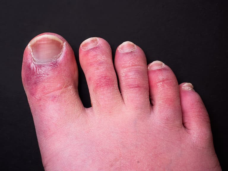 Did you get ‘Covid toes?’ Research shows new side effect of virus Did you get ‘Covid toes?’ Research shows new side effect of virus
