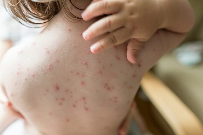 Concerns about increase in chickenpox cases in Ireland