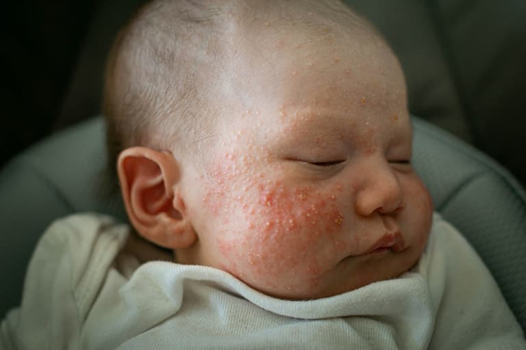 ‘This budget-friendly soap cleared up my daughter’s eczema in one week’ ‘This budget-friendly soap cleared up my daughter’s eczema in one week’