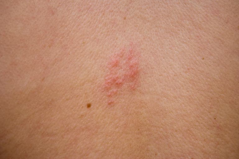 HSE issues shingles warning – here are the symptoms to look out for